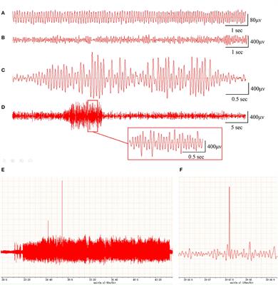 Identification of miRNA–mRNA regulatory network associated with the glutamatergic system in post-traumatic epilepsy rats